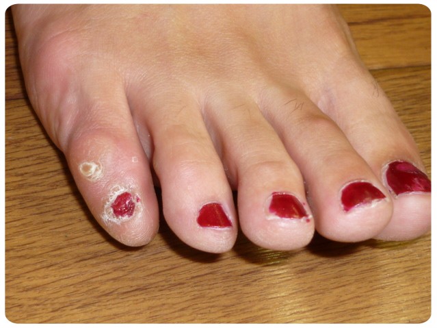 足 の 小指 の タコ 治療